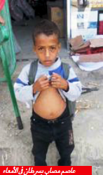 الطفل عاصم مصاب بسرطان المعدة-تصوير:حسان